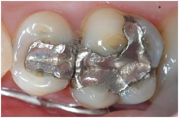 Dental_amalgame